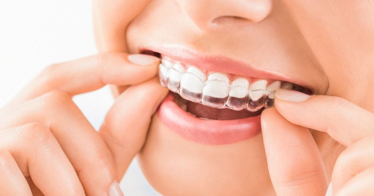 ¿Es Invisalign adecuado para mí?