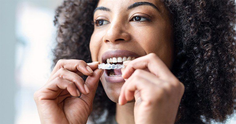 Invisalign: Lo que necesitas saber sobre el proceso